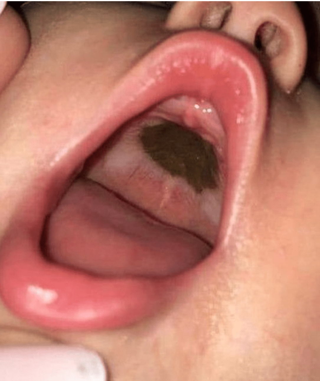 She noticed a dark mark in her daughter’s mouth and quickly brought her to the hospital.