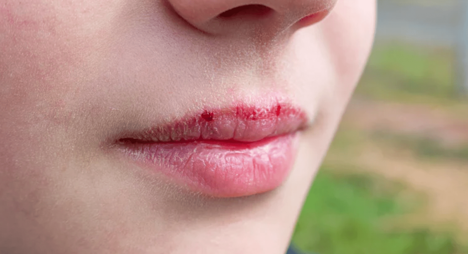 Tips for Soothing Painful Sunburn on Lips