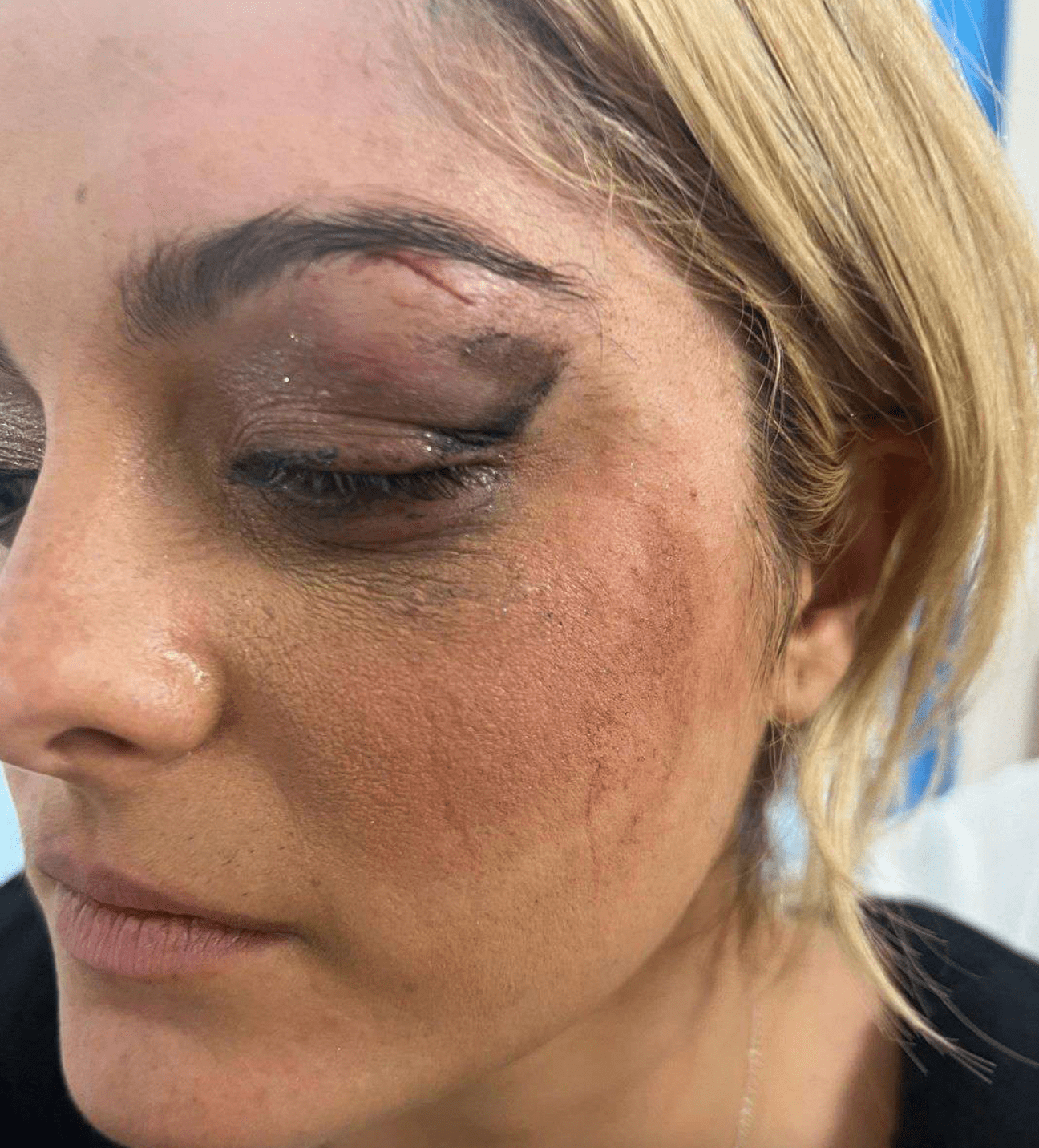 Bebe Rexha ‘Good’ After Getting Hit in the Face with a Phone: Singer Needed Stitches as Man Was Arrested