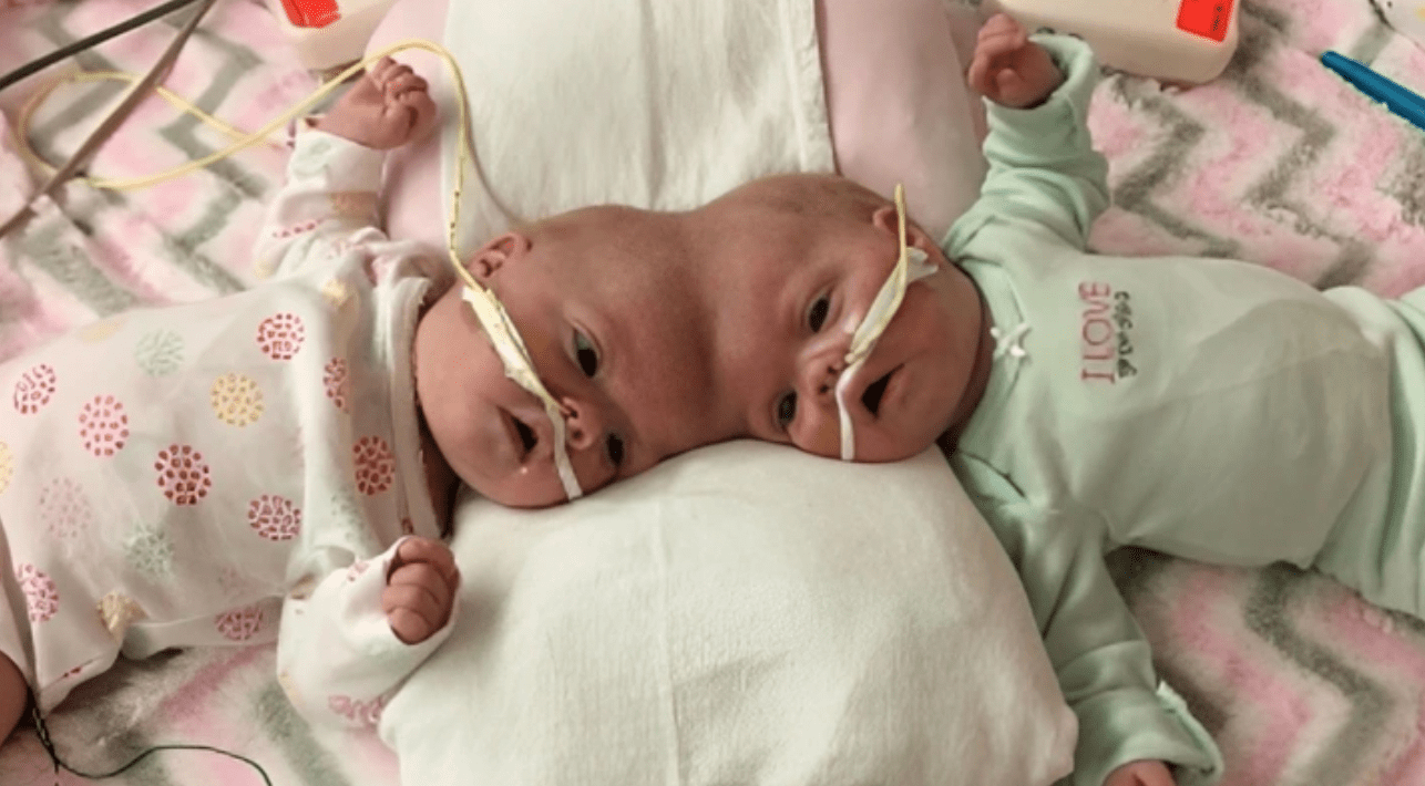 Formerly Conjoined Twins Survive Against a 2% Chance and Achieve Their First Life Objective