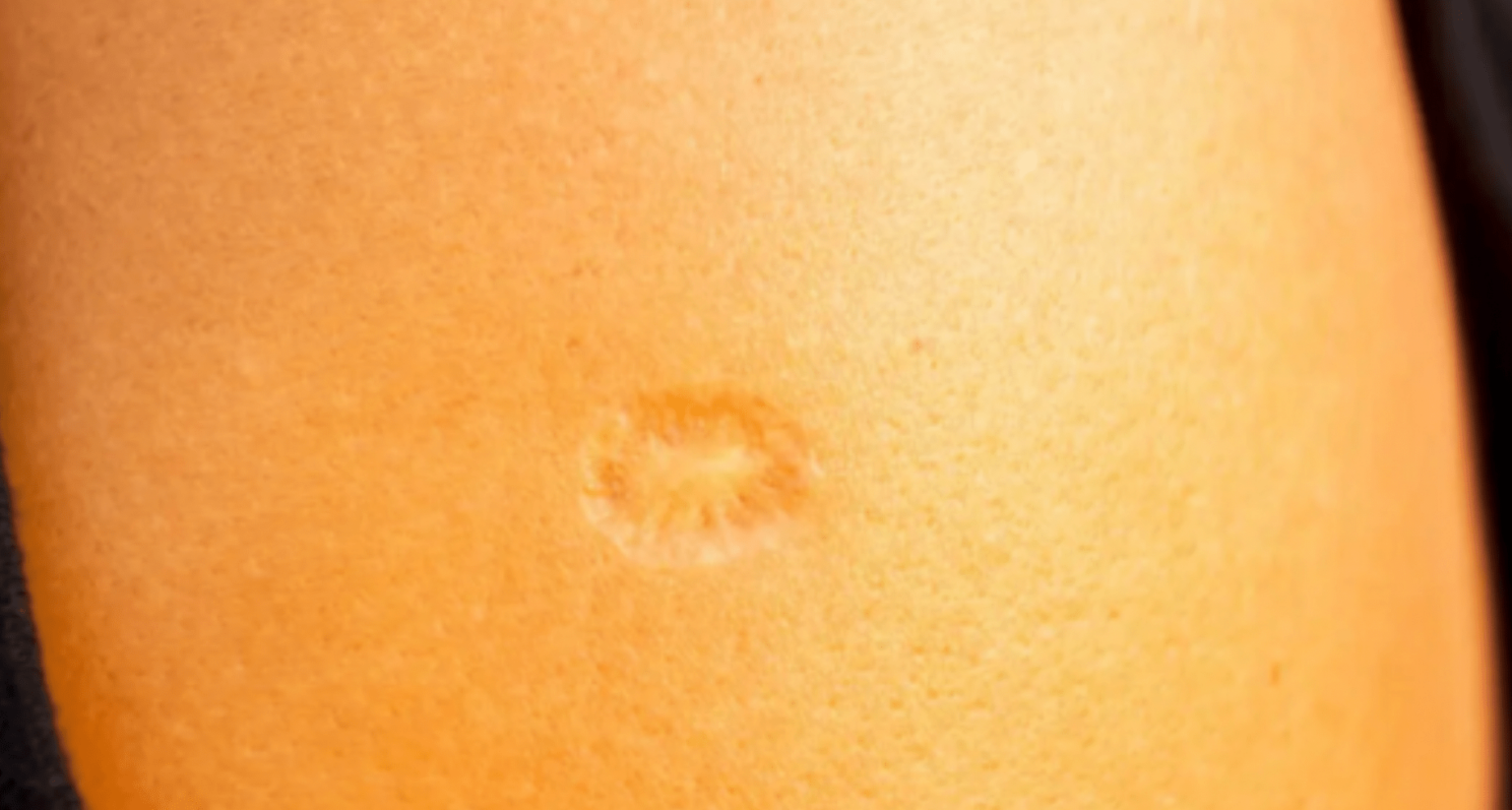 The Fascinating Story Behind the Smallpox Scar on Your Upper Left Arm