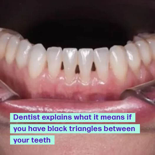 Understanding Black Triangles Between Teeth