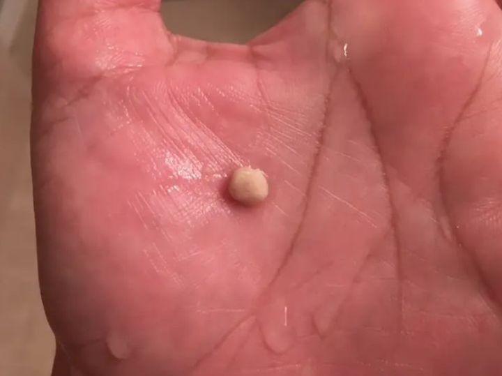 The Tonsil Stone Phenomenon: A Satisfying Experience