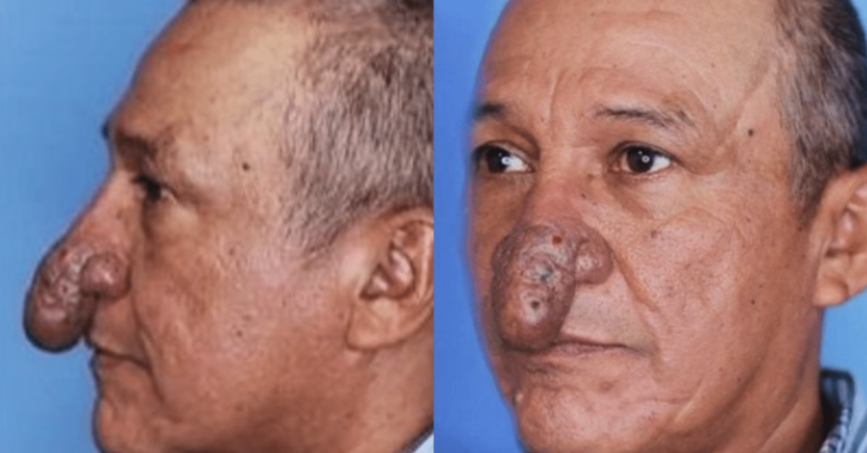 Conrado’s Extraordinary Journey: The Power of Plastic Surgery